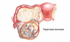 Тератома яичника. Что это такое у женщин, клинические рекомендации