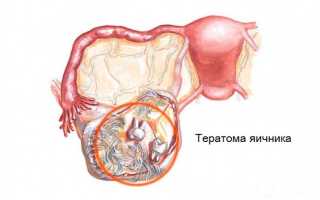 Тератома яичника. Что это такое у женщин, клинические рекомендации