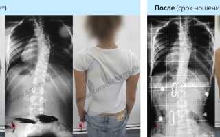 Корсет Шено для позвоночника при сколиозе 2-3-4 степени, кифозе