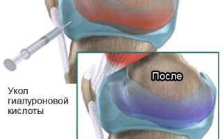 Биоимпланты коленного сустава. Цена, отзывы