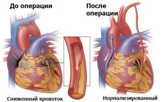Реваскуляризация миокарда коронарная. Что это такое