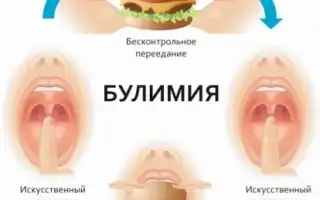 Булимия. Что это за болезнь, симптомы, причины возникновения, лечение