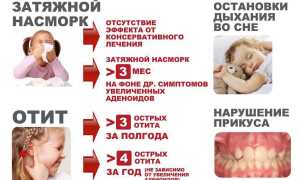 Хронический аденоидит у детей. Симптомы, лечение