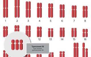 Трисомия 18 (Синдром Эдвардса). Нормальные показатели в 12-13-14 недель
