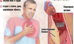 Боли в области сердца в состоянии покоя. Что это