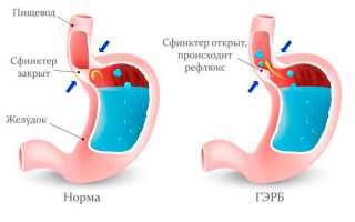 Гастро-эзофагеально-рефлюксная болезнь. Симптомы и лечение