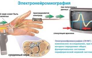 ЭНМГ нижних/верхних конечностей. Что это такое, цена обследования, как делают