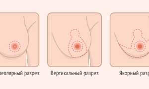 Мягкая грудь. Причины, почему стала мягкой, если одна твердая, а другая мягкая