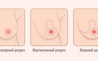 Мягкая грудь. Причины, почему стала мягкой, если одна твердая, а другая мягкая