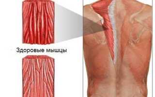 Полимиозит. Что это, симптомы и лечение, диагностика