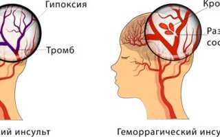 Ишемический инсульт. Последствия, неврология, лечение у взрослых, пожилых, детей, диагностика, восстановление