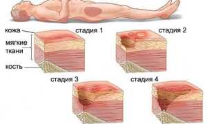 Профилактика пролежней. Что это такое, как выглядят, фото, виды