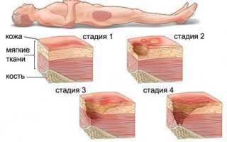 Профилактика пролежней. Что это такое, как выглядят, фото, виды