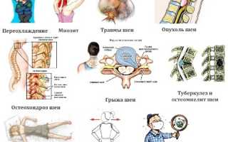Причины болевых ощущений на шее сзади. Возможные заболевания и проблемы со здоровьем