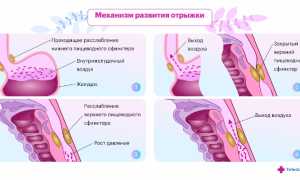 Отрыжка воздухом без запаха постоянно. Причины и лечение