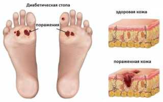 Диабетическая стопа. Лечение, препараты, мази, профилактика