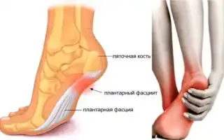 Подошвенный апоневроз стопы. Что это такое, симптомы, лечение