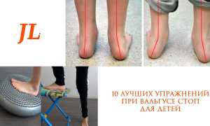 Упражнения для стоп при плоскостопии, вальгусной деформации
