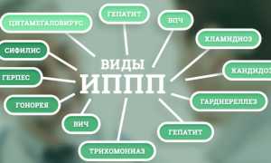 ЗППП (заболевания передающиеся половым путем) у женщин. Симптомы, таблица