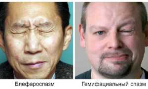 Блефароспазм в офтальмологии. Что это, причины, лечение