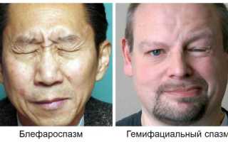 Блефароспазм в офтальмологии. Что это, причины, лечение