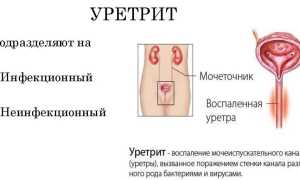 Уретрит у мужчин. Симптомы и лечение