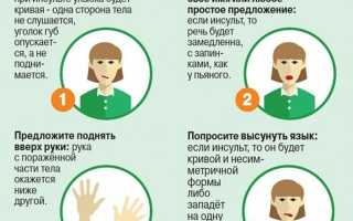 Микроинсульт у молодых девушек. Симптомы, возраст, лечение
