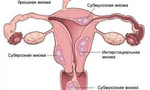 Миома матки. Чем опасна во время беременности, менопаузы