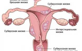 Миома матки. Чем опасна во время беременности, менопаузы