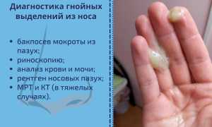 Гнойные выделения из носа, желтые густые сопли, запах гноя. Чем лечить