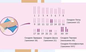 Синдром Эдвардса. Что это такое, причины, кариотип, симптомы, лечение