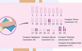 Синдром Эдвардса. Что это такое, причины, кариотип, симптомы, лечение