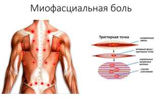Миофасциальный массаж. Что это такое, для чего нужен