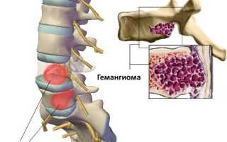 Гемангиома в теле позвонка l1-l2-l3-l4, th7-th10-th12. Что это такое