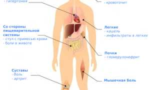 Васкулит. Что это такое, симптомы, лечение, диагностика сосудов