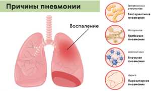 Опасность пневмонии. Осложнения, последствия болезни