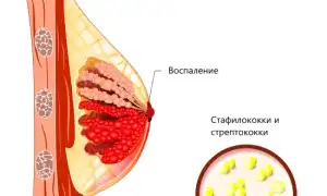 Гнойный мастит у женщин. Что это такое, лечение, фото