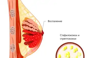 Гнойный мастит у женщин. Что это такое, лечение, фото