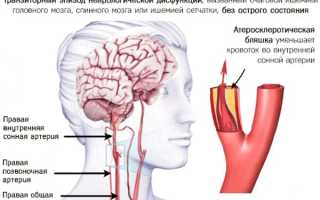Транзиторная ишемическая атака. Что это такое, причины, симптомы, лечение