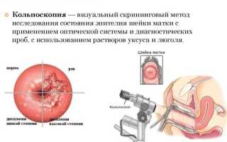 Расширенная кольпоскопия. Что это за анализ, что показывает, показания, подготовка