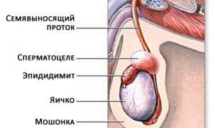 Киста придатка яичка у мужчин. Последствия сперматоцеле
