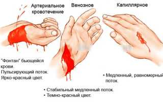 Капиллярное кровотечение. Как остановить: способы, алгоритм, первая помощь. Отличия от венозного