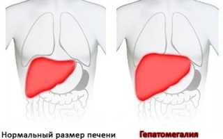 Умеренная гепатомегалия печени. Что это такое у взрослого, ребенка