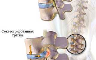 Секвестрация грыжи межпозвоночного диска. Что это такое, симптомы, лечение