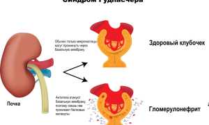 Синдром Гудпасчера это что такое. Диагностика, симптомы