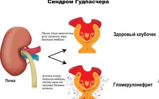 Синдром Гудпасчера это что такое. Диагностика, симптомы