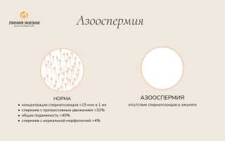 Азооспермия. Что это такое, лечится или нет