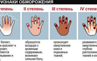 Первая помощь при ожогах и обморожениях кожи. Степени, правила