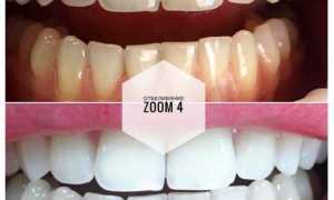 Отбеливание Зум 4 (Zoom 4). Что это такое, инструкция, отзывы, цена
