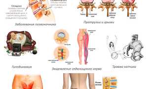 Кокцигодиния у женщин. Симптомы и лечение, отзывы врачей
